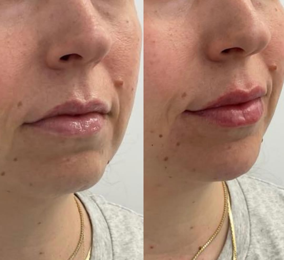 Instagram post by Dr. Dennis Gross: A peak into some of the amazing work being done in our office!👏🏻 Pictured is filler to the lip and chin area done by the wonderful @dermby…