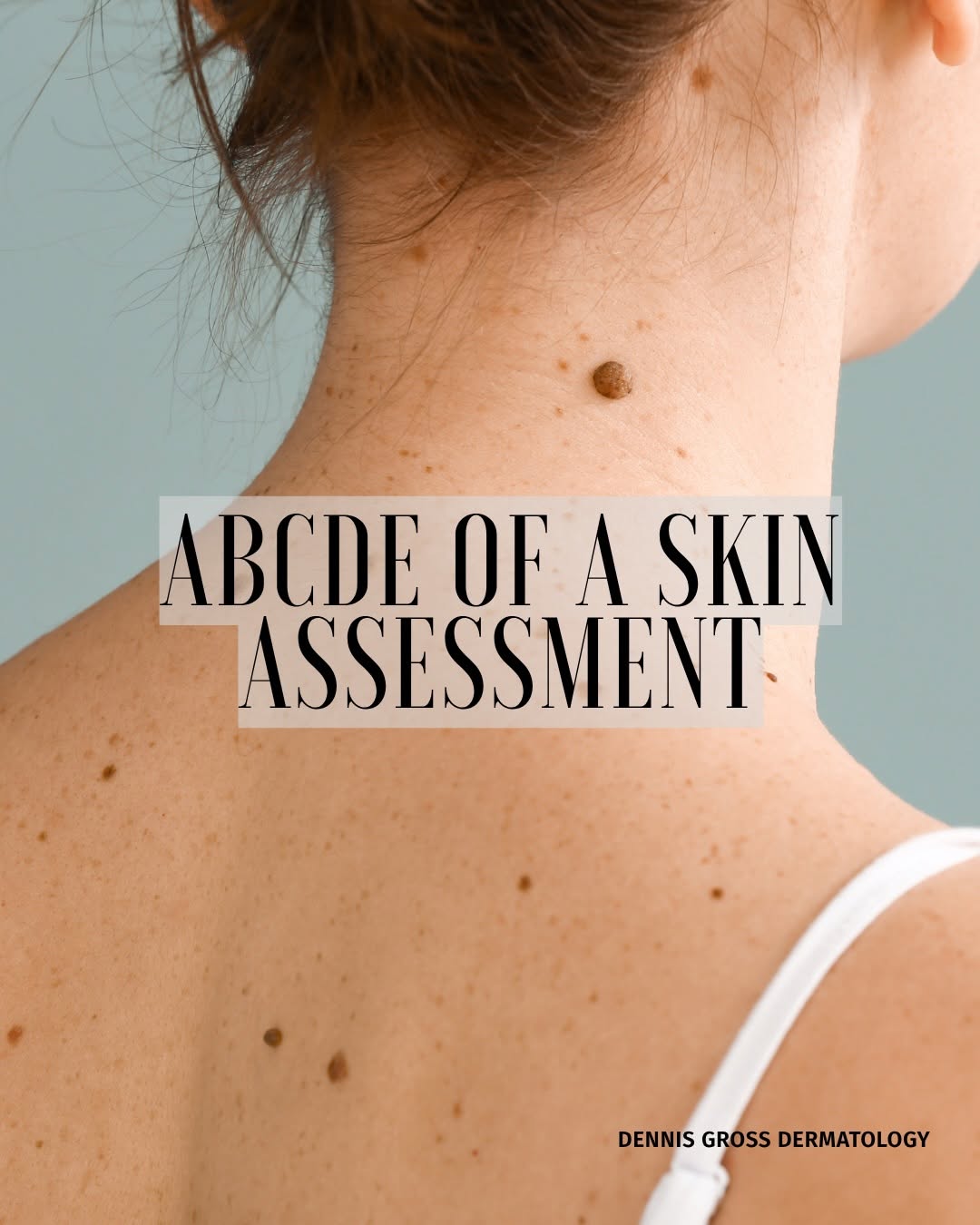 Instagram post by Dr. Dennis Gross: Save this to know what to look for and to keep your skin healthy👏🏻 #abcde #molecheck #nycdermatologist #drdennisgross