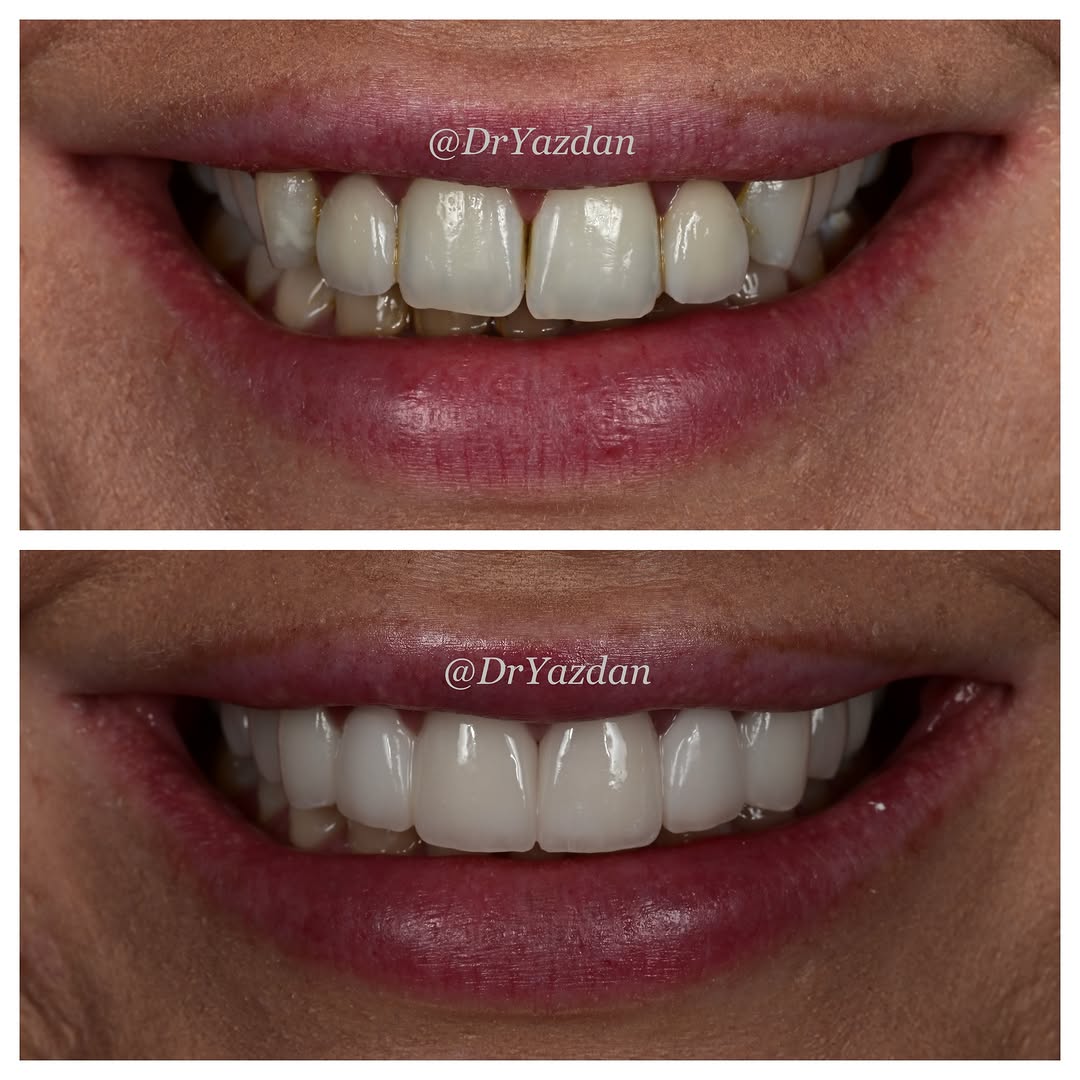 Instagram post by Dr. Desiree Yazdan: There’s a misconception that crowns and bridges have to look “fake” or overly perfect. They don’t. When the shape, color, translucency, text…