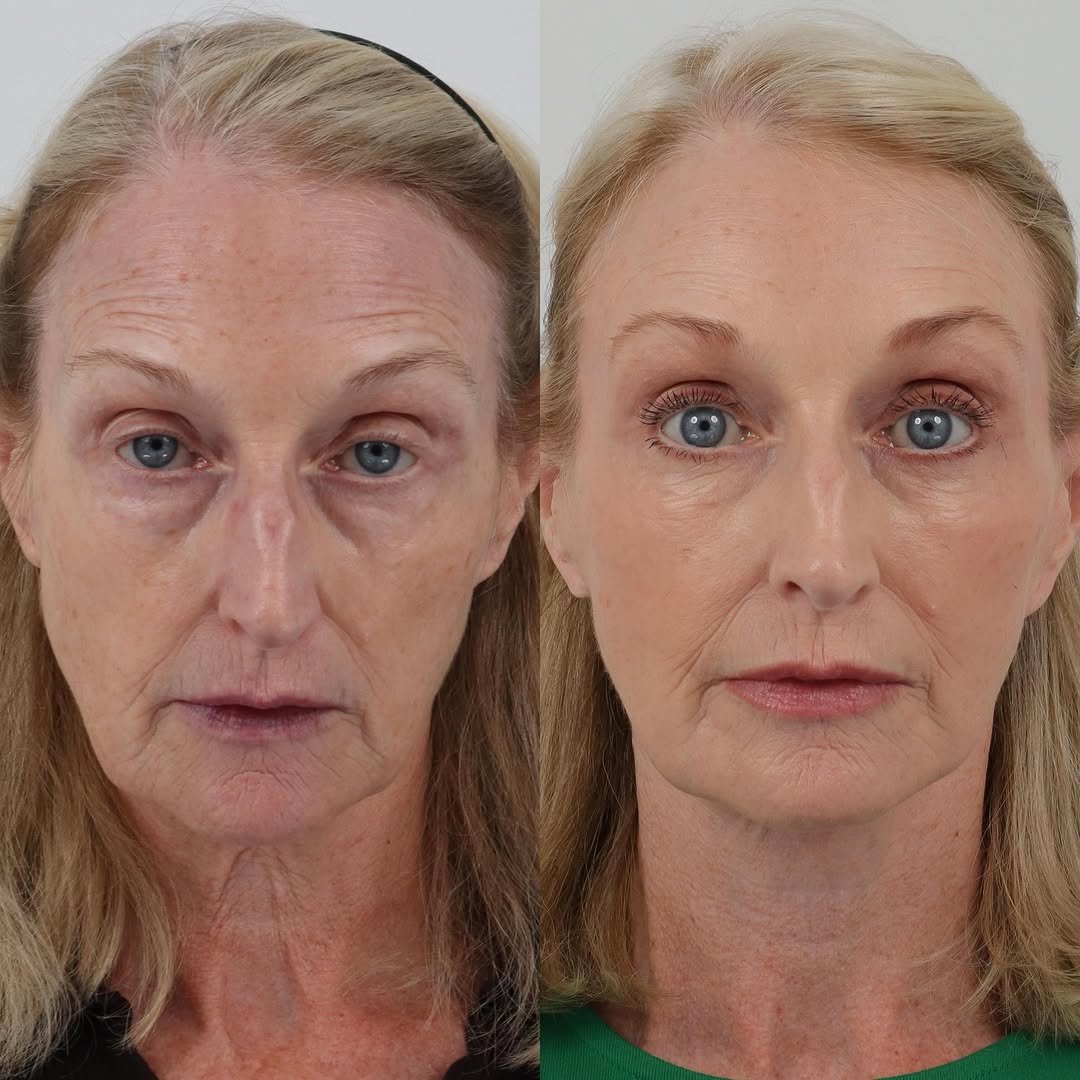 Instagram post by Dr. Dilip D. Madnani: My 66 year old patient is 6 months after her facelift, neck lift, brow lift, lower blepharoplasty, facial fat transfer, and TCA chemical pee…
