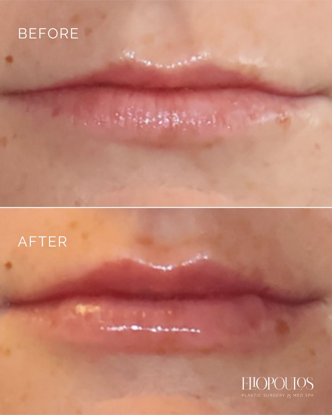 Instagram post by Dr. Dina Eliopoulos: For this patient, we used one syringe of Juvéderm Ultra XC to add soft volume and definition, along with a Botox lip flip to gently relax th…