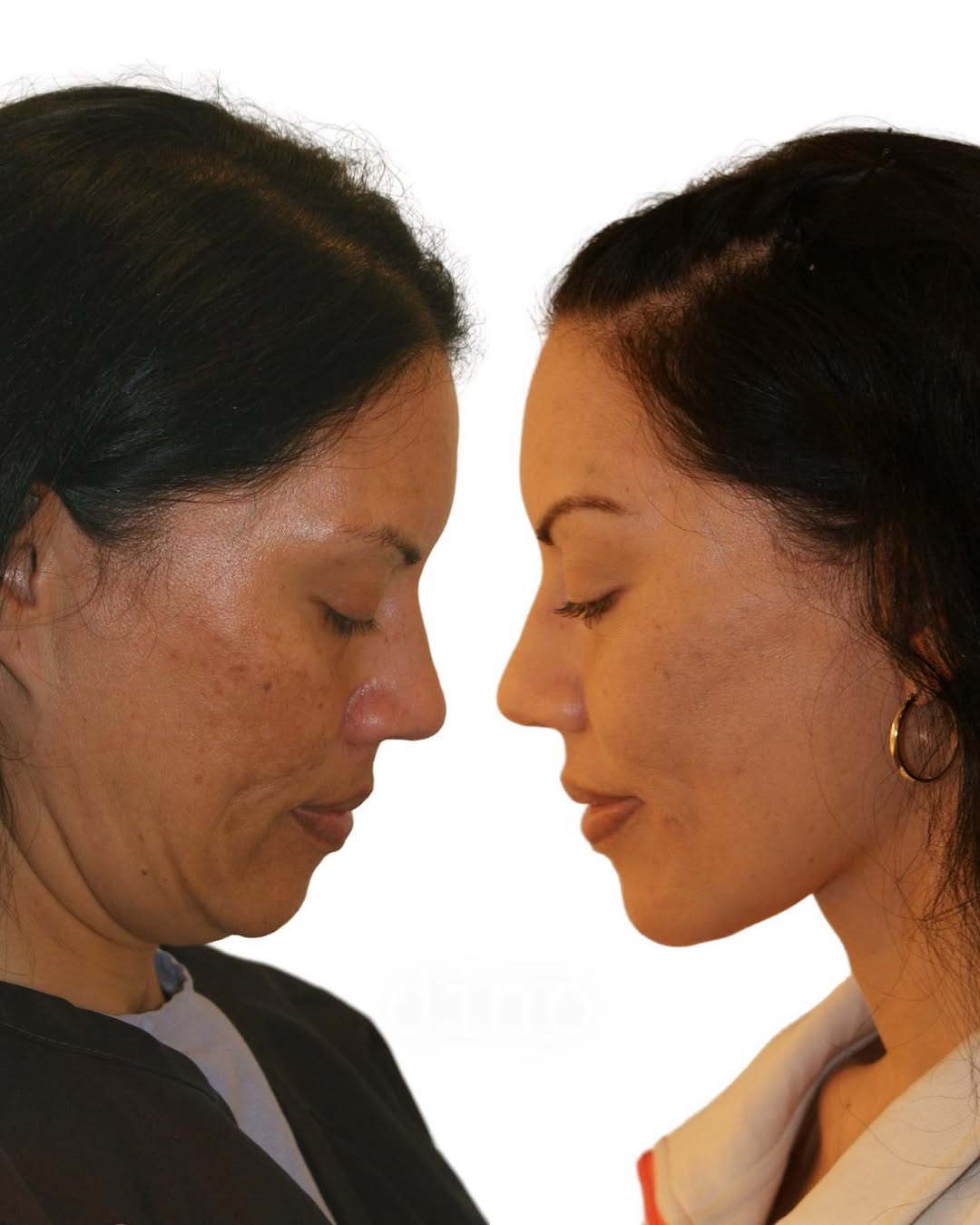 Instagram post by Dr. Dino R. Elyassnia: This patient underwent a facelift, necklift, facial fat grafting, and a nostril reduction and is seen before and 4 months after the procedur…