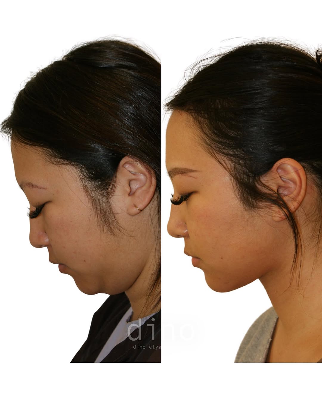 Instagram post by Dr. Dino R. Elyassnia: Our lovely Operating Room Nurse is 3 months out after her Short Scar Neck Lift performed by Dr. Elyassnia! 👏 Her results beautifully dis…