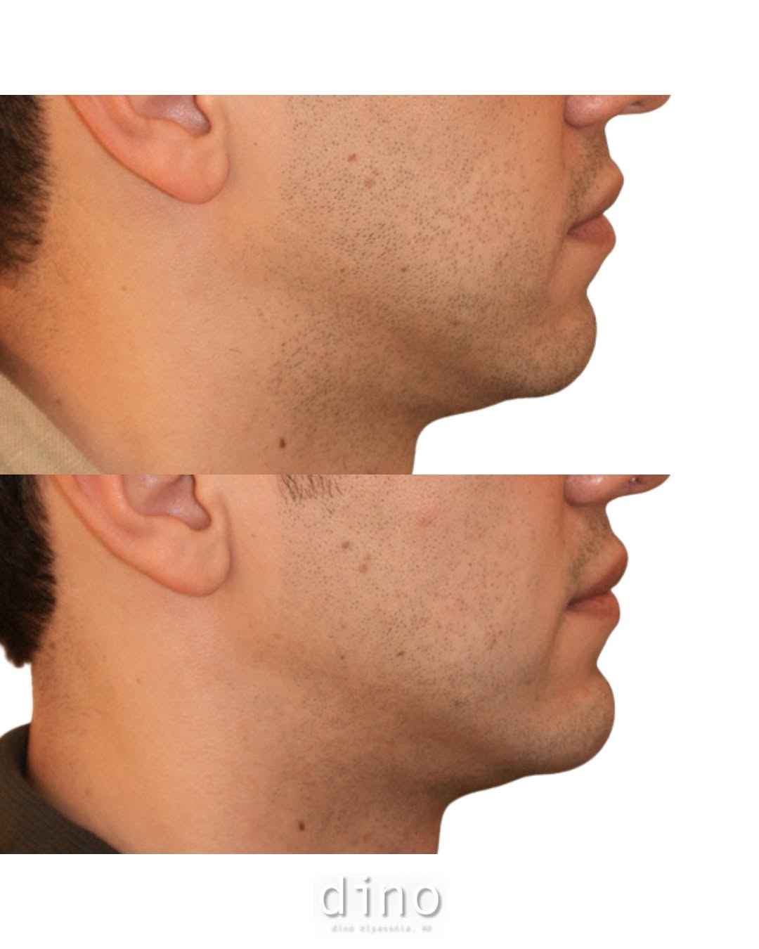 Instagram post by Dr. Dino R. Elyassnia: MALE CHIN IMPLANT: A chin implant doesn't just change the chin, it changes how the whole profile reads. Stronger jawline, better profile bal…