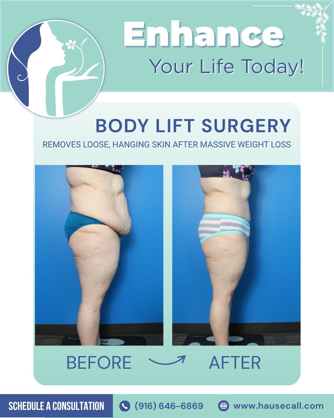 Instagram post by Dr. Donald W. Hause: Major weight loss can leave behind stretched skin and weakened tissues that do not conform to your new shape. Body Lift surgery removes exce…
