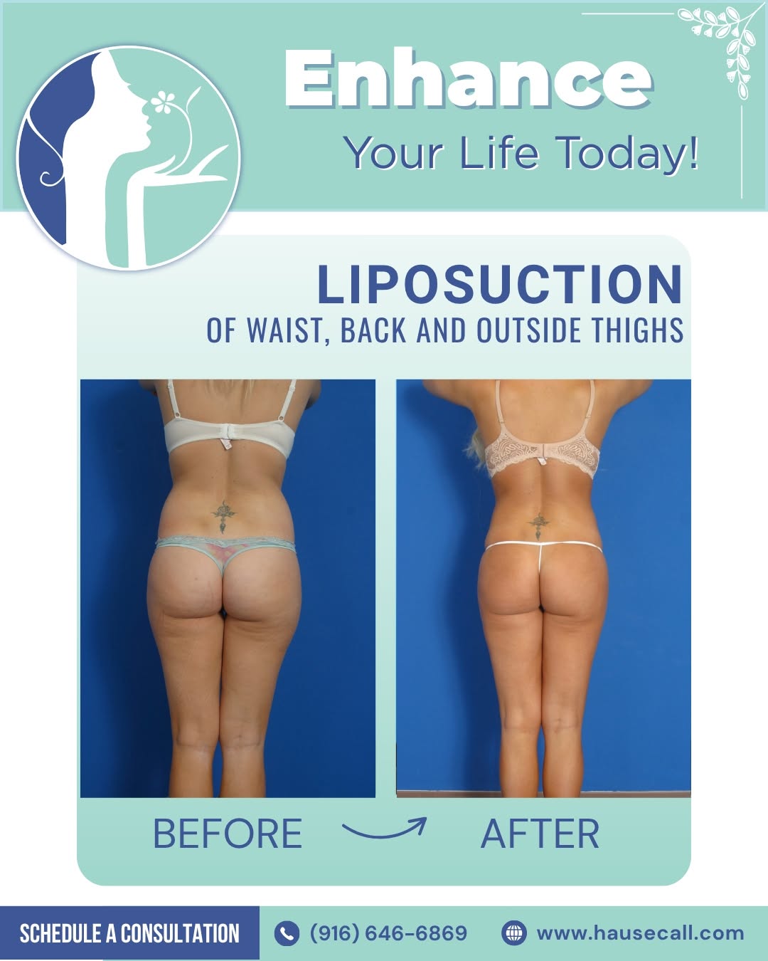 Instagram post by Dr. Donald W. Hause: Stubborn pockets of fat around the waist, back, and outer thighs can persist despite consistent diet and exercise efforts. Liposuction targe…