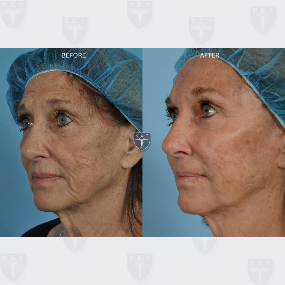 Instagram post by Dr. Douglas J. Key: ❗️Before & After❗️ This patient was treated with dermal fillers to enhance the cheeks and smooth the area around the mouth, along with Bo…