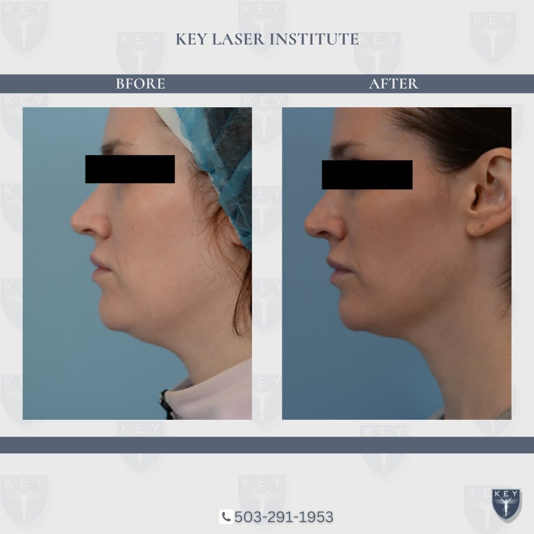 Instagram post by Dr. Douglas J. Key: ❗️Transformative Results❗️ Witness the power of Ultherapy before and after for cheeks and under chin after 1 treatment! With focused ultraso…