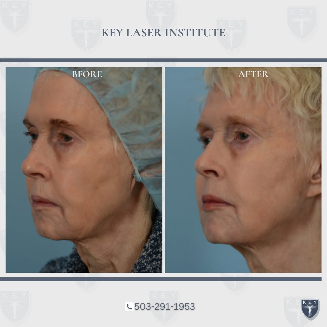 Instagram post by Dr. Douglas J. Key: ❗️BEFORE & AFTER❗️ Our patient experienced a remarkable before and after with Novathreads, specifically targeting the jawline and upper ne…