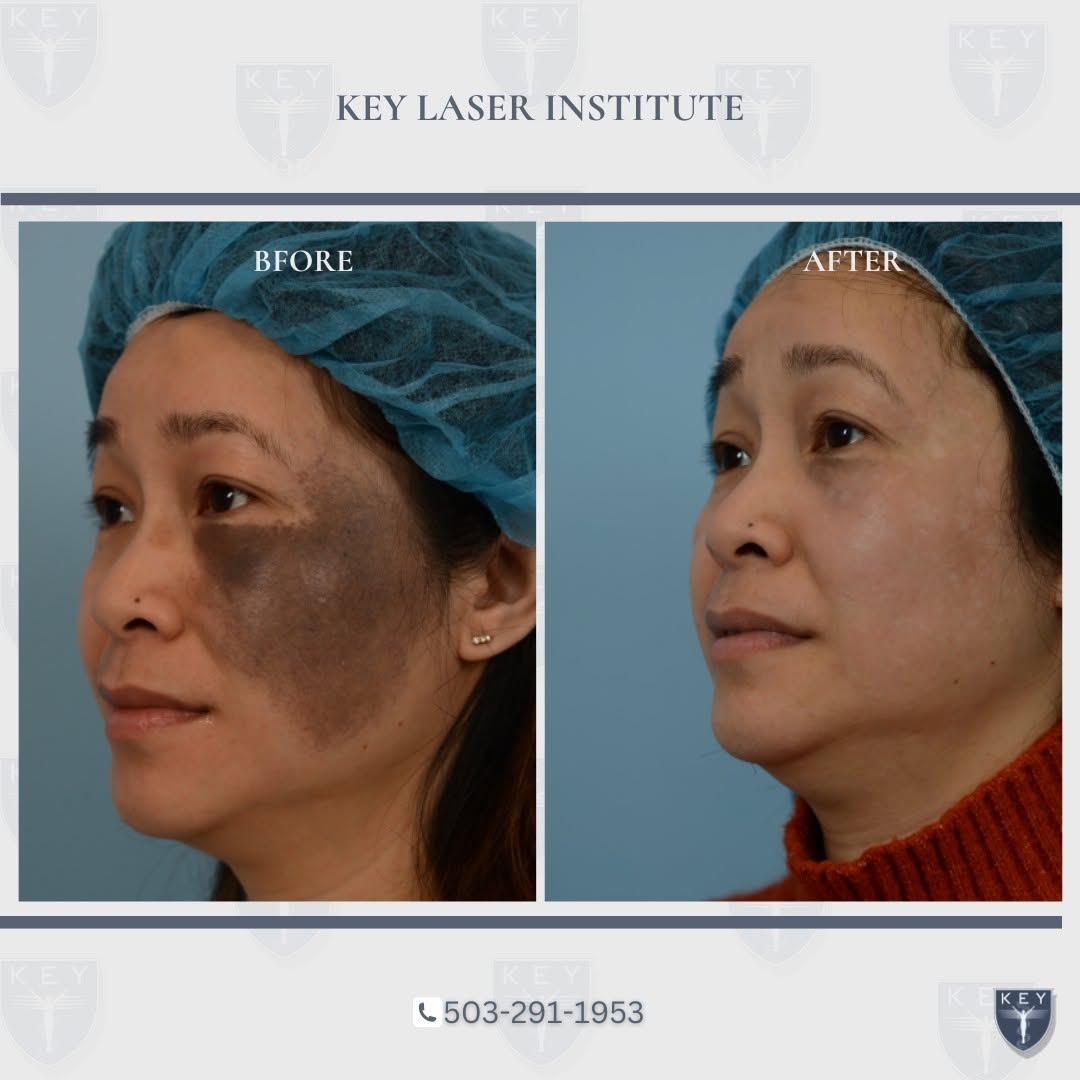 Instagram post by Dr. Douglas J. Key: At Key Laser Institute, our priority is ensuring our patients' satisfaction and confidence. Utilizing our PicoSure technology and consistent…