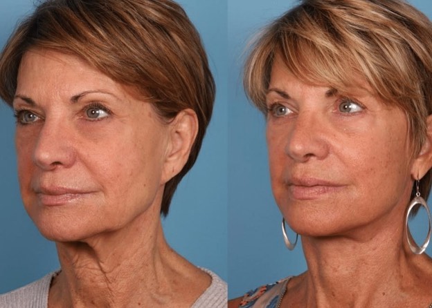 Instagram post by Dr. Douglas Sidle: Facelift Friday 👨🏼⚕️ before/after