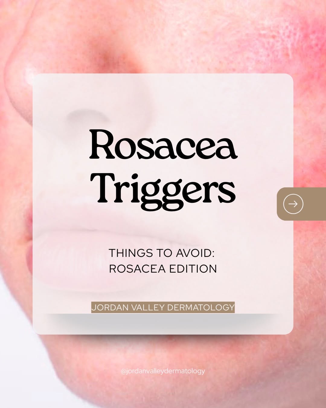 Instagram post by Dr. Douglass W. Forsha: Rosacea is an inflammatory skin condition that mainly affects the face, causing persistent facial redness, flushing, visible blood vessels, …