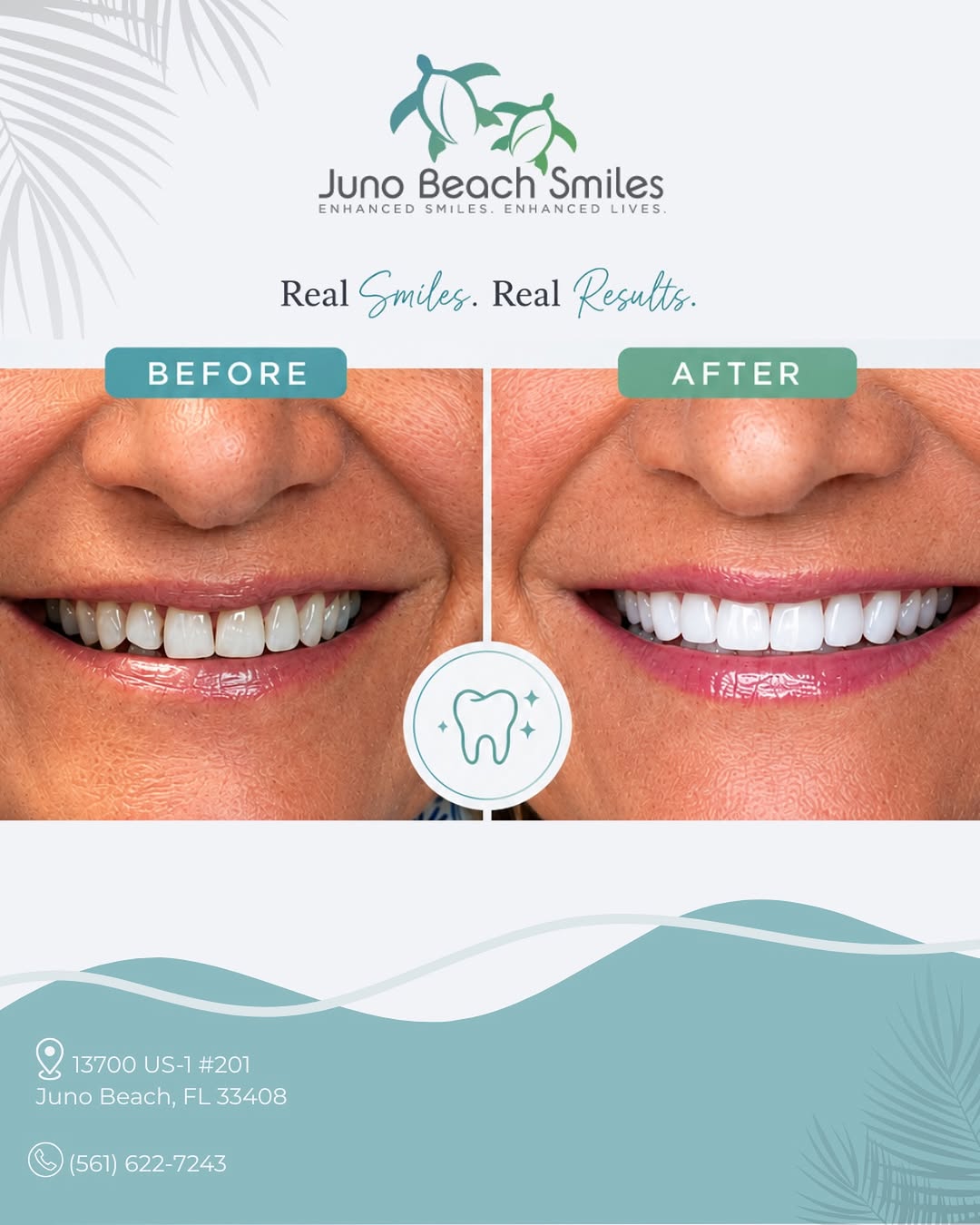 Instagram post by Dr. Duane E. Keuning, D: ✨ A beautiful smile is all about the details. ✨ This stunning smile transformation features six custom porcelain veneers on the upper teeth,…