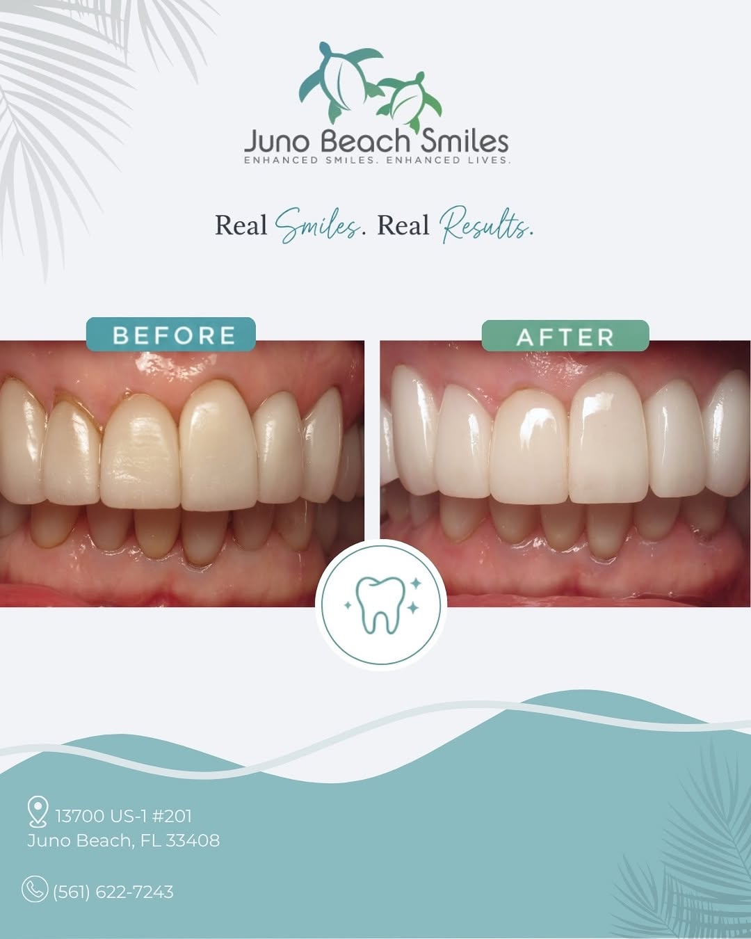 Instagram post by Dr. Duane E. Keuning, D: This incredible transformation features 10 upper veneers and 6 lower veneers, carefully designed to create a brighter, more balanced, and na…