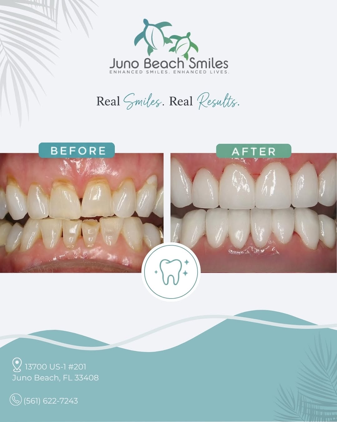 Instagram post by Dr. Duane E. Keuning, D: ✨ From before to a brand new smile! ✨ A smile transformation is about more than just changing the appearance of your teeth, it’s about resto…