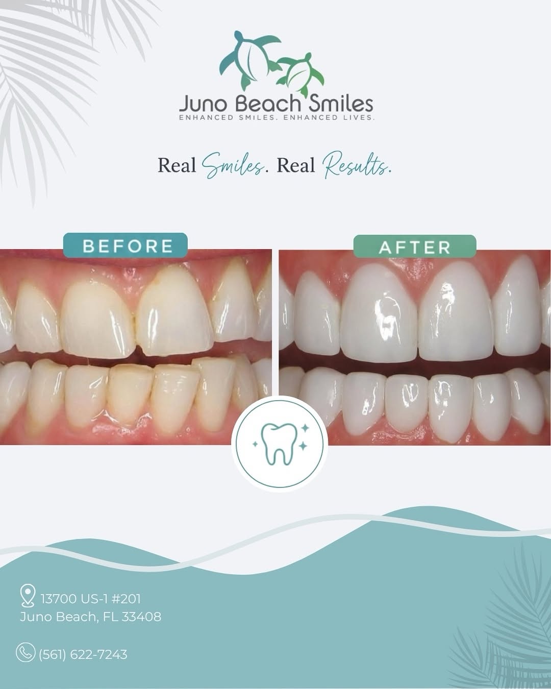 Instagram post by Dr. Duane E. Keuning, D: Real results of a huge smile diffference! 🦷