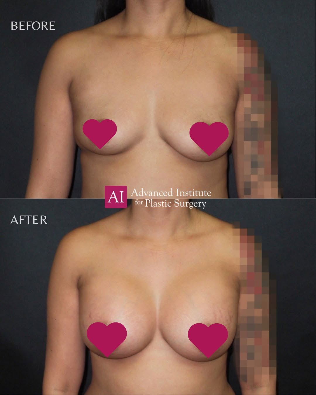 Instagram post by Dr. Duncan Miles: This patient received: ✔ Saline implants ✔ High profile | Smooth, round shell ✔ 505 cc (R) / 425 cc (L) — for a balanced, symmetrical result…