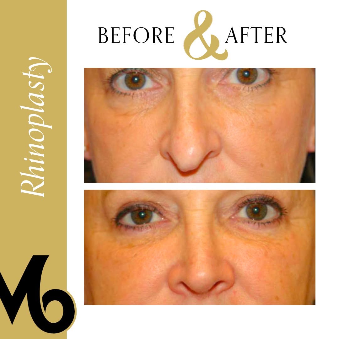 Instagram post by Dr. E. Gaylon McCollough: Rhinoplasty | Before & After An aging nose often droops, subtly altering your facial harmony and restricting airflow. A rhinoplasty by Dr. M…