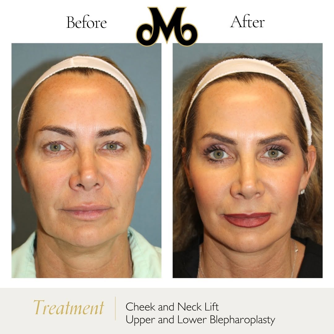 Instagram post by Dr. E. Gaylon McCollough: Facelift | Before & After A fantastic Facelift and Blepharoplasty performed by Dr. McCollough! This 49-year-old patient had a cheek and neck…