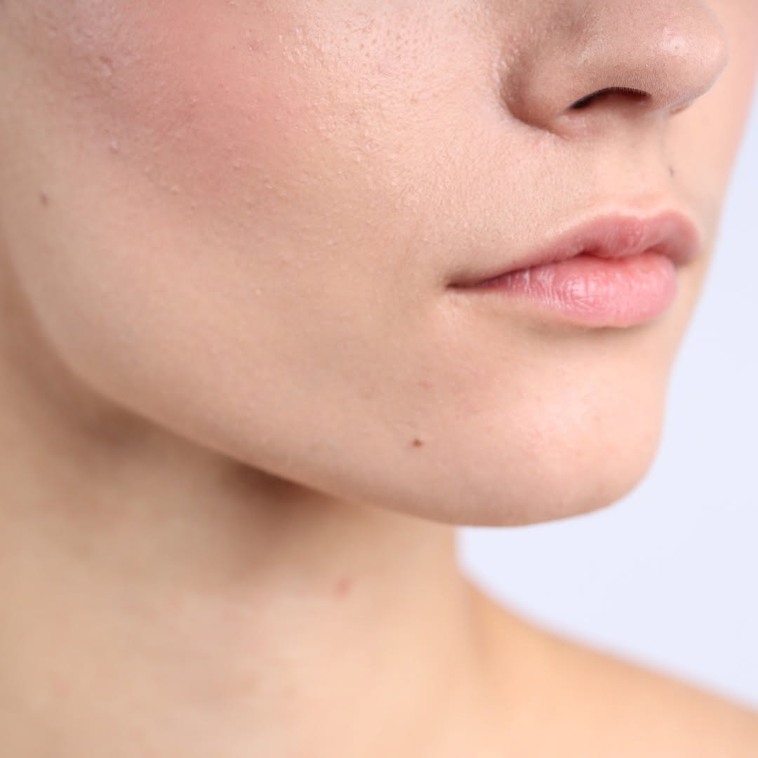 Instagram post by Dr. E. Michael Tachuk: Those little diagonal lines on either side of your nose when you scrunch your face? Those are bunny lines, and a few units of Botox smooths …
