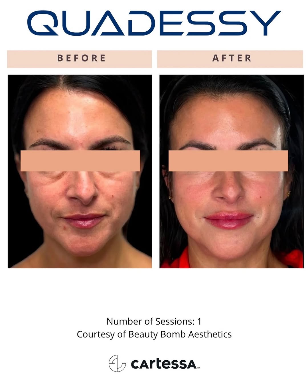 Instagram post by Dr. Earlyn Noll: Texture. Tone. Collagen. ✨ A look at what Quadessy can do. This radiofrequency microneedling treatment combines controlled microneedling wit…