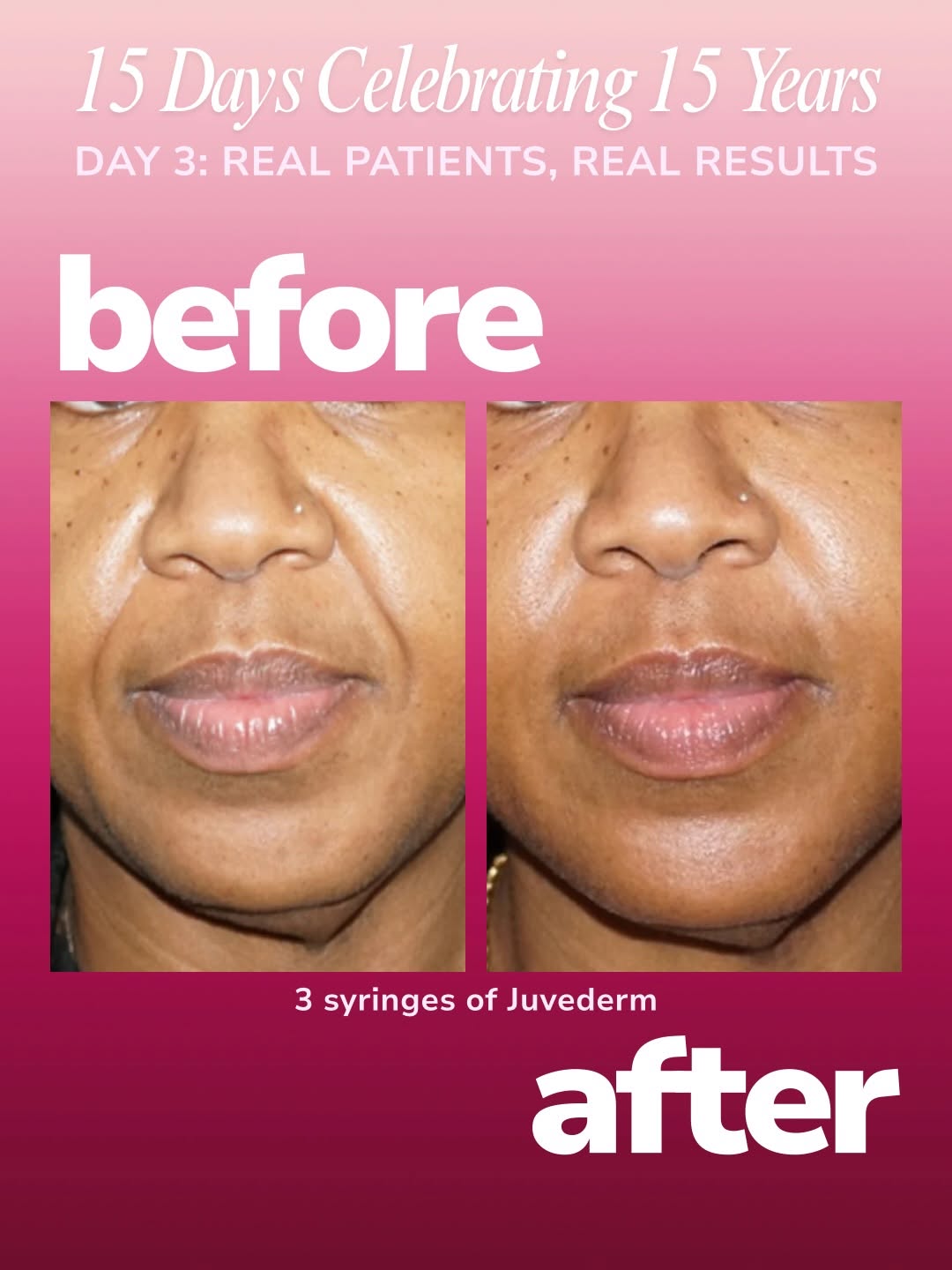 Instagram post by Dr. Earlyn Noll: Day 3: The Results Over the past 15 years, we’ve had the opportunity to help patients feel more confident in their skin through personalized…