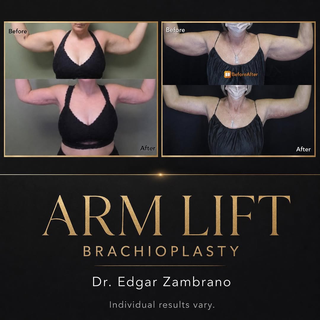 Instagram post by Dr. Edgar Zambrano, DO: Confidence looks good at every age. An arm lift, also called brachioplasty, removes excess skin and reshapes the upper arms for a smoother, …