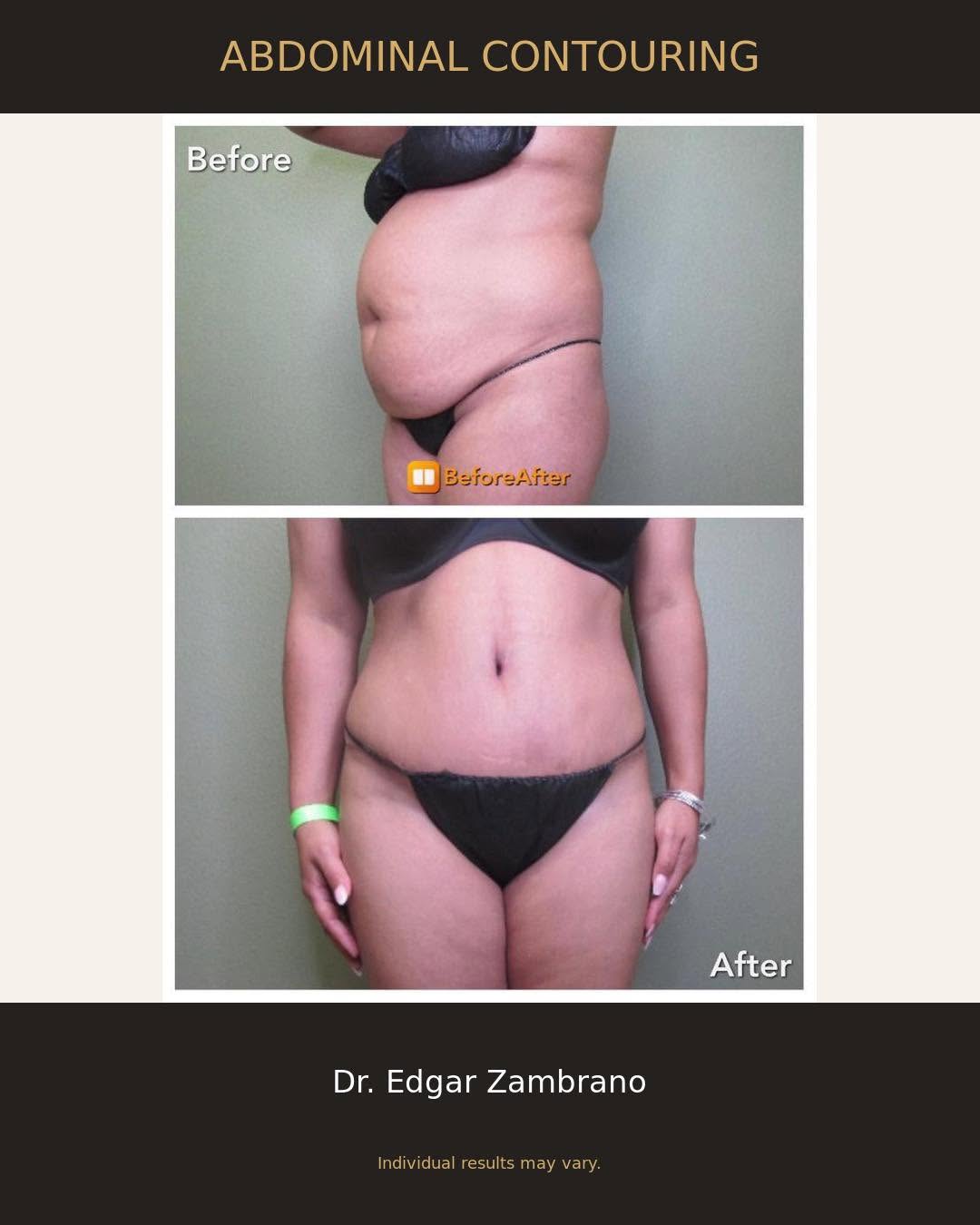 Instagram post by Dr. Edgar Zambrano, DO: Caption: A beautiful change in contour and confidence. Every treatment plan is tailored to the patient’s unique goals and anatomy. Schedule …