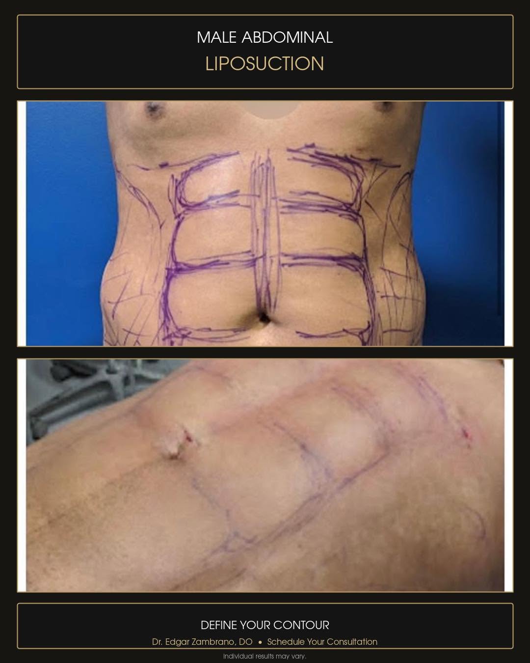 Instagram post by Dr. Edgar Zambrano, DO: Defined. Masculine. Confident. This male abdominal liposuction transformation was designed to enhance natural contours and create a more scu…