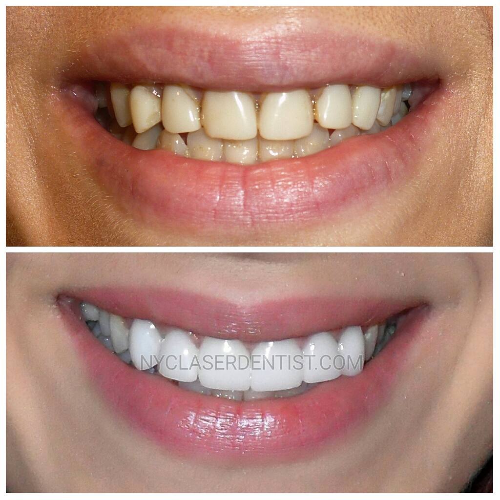 Instagram post by Dr. Edward A. Alvarez: A #beautiful #smile #makeover done by Dr. Alvarez. The six front #teeth had #sameday #veneers #designed by Dr.Alvarez and made in the office…