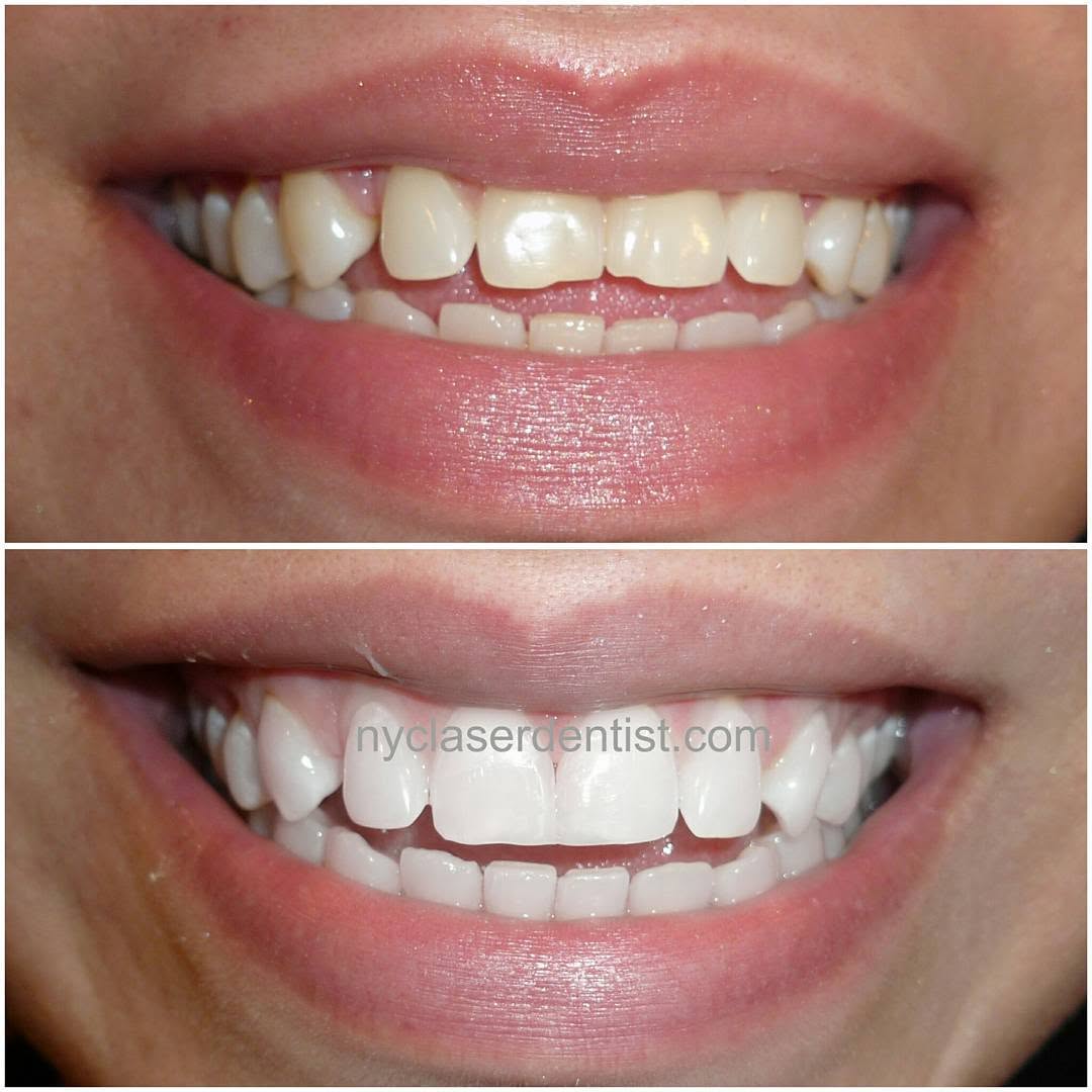 Instagram post by Dr. Edward A. Alvarez: #Bonding and #whitening done by DrAlvarez on the two front #teeth as an alternative to #veneers #beautiful #smile #makeover #CEREC #Dentistr…