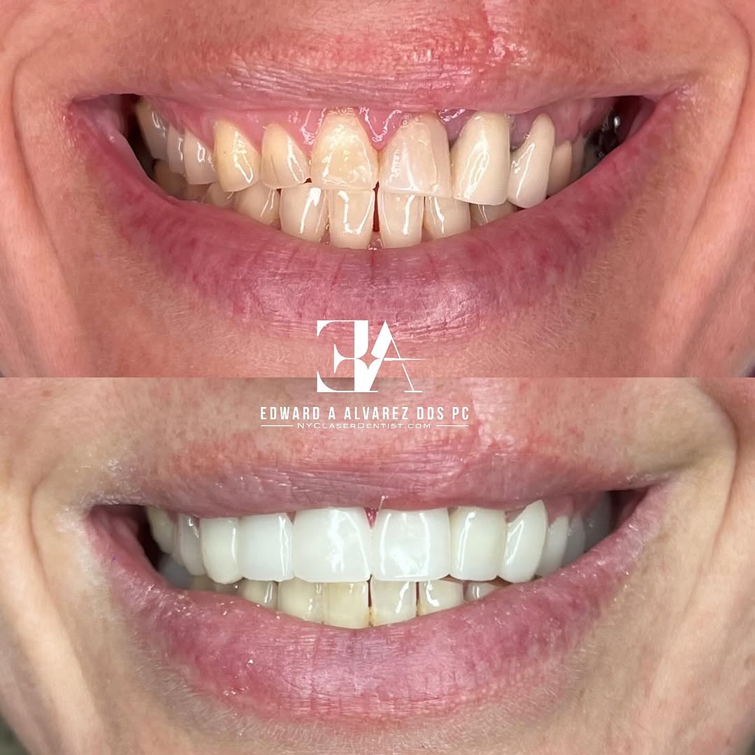 Before and after smile makeover by Dr. Edward Alvarez