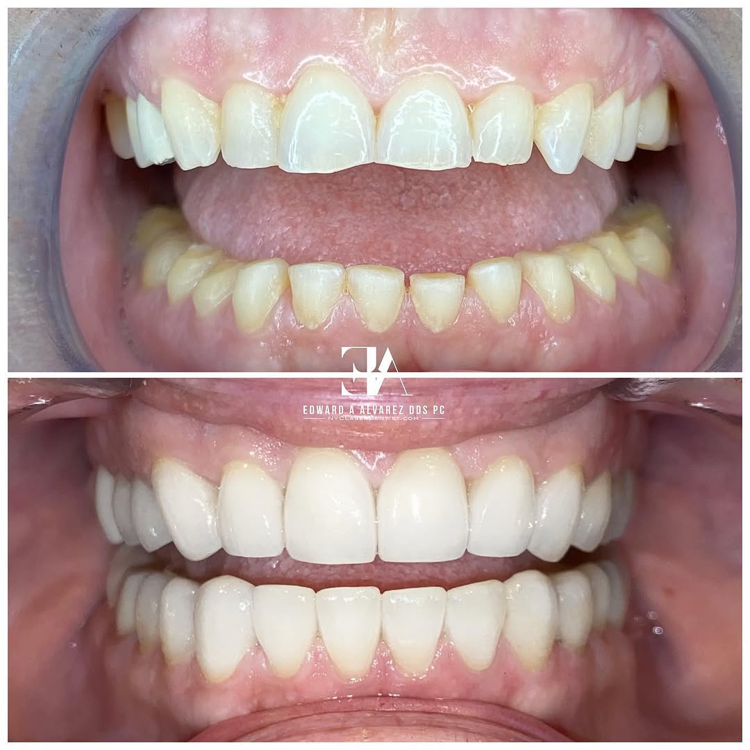 Instagram post by Dr. Edward A. Alvarez: One of my favorite cases on one of my favorite patients ever. We prepped 28 teeth to do a full mouth reconstruction to repair damage done by…