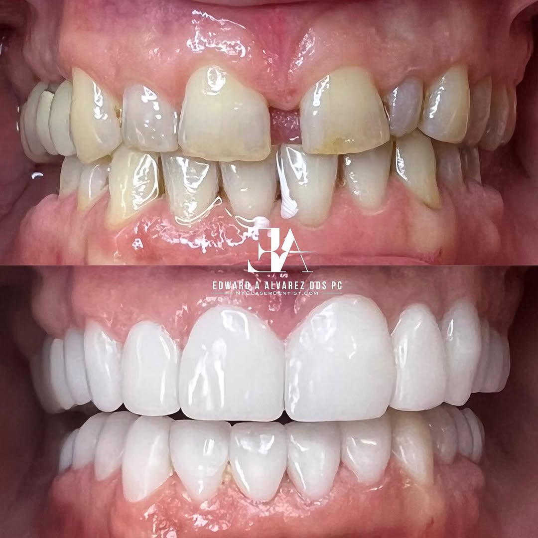 A new smile. 24 CEREC crowns and veneers done in the office, hand designed and contoured by Dr. Edward Alvarez. No Invisalign, no lab, no impressions, and no more gap.