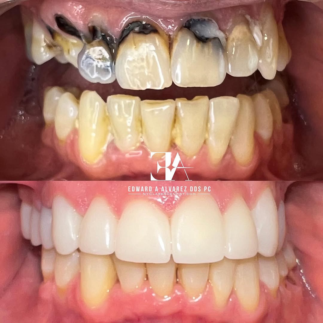 Dental smile makeover by Dr. Edward Alvarez NYCLaserDentist same day dentistry with CEREC