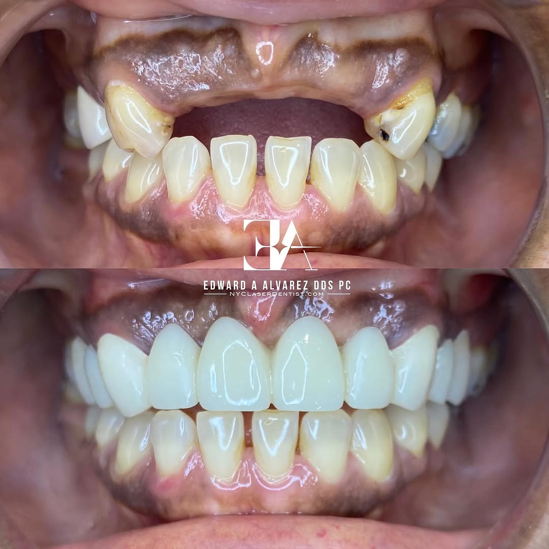 Smile makeover with a new all ceramic dental bridge by Dr. Edward Alvarez cosmetic dentist in New York City. Digital dentistry.