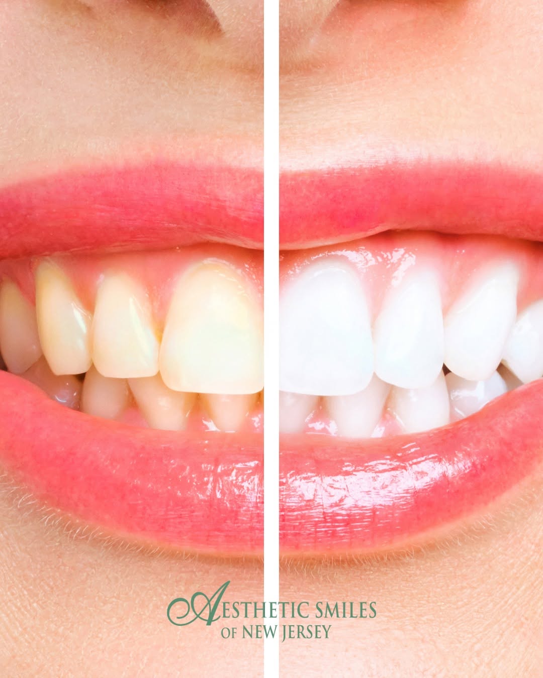 Instagram post by Dr. Edward A. Romano, DDS: You brush. You floss. You do everything right, and your teeth still don’t look the way you want them to. Professional whitening can help lif…