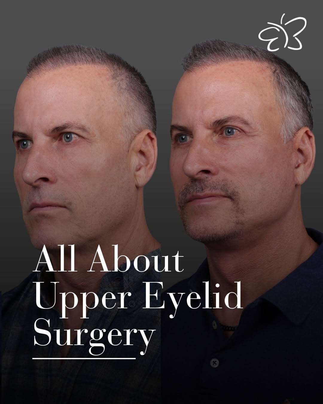 Instagram post by Dr. Edward Buckingham: A great compliment to a deep plane lower facelift is upper eyelid rejuvenation. Which achieved impeccable results for this patient. This can…