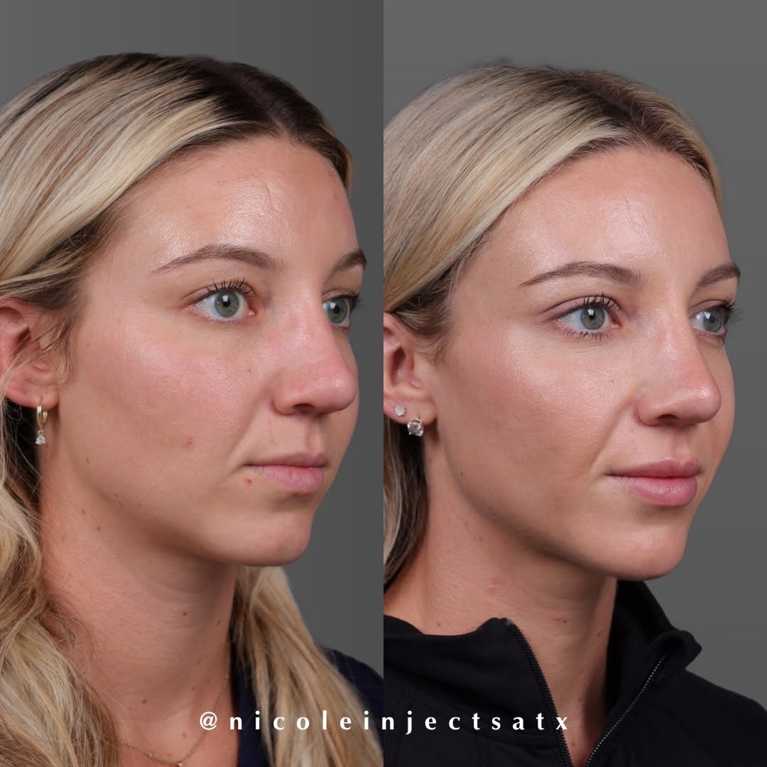 Instagram post by Dr. Edward Buckingham: Before (2024) > After (2026) This patient has trusted me with her aesthetic care for the past two years, allowing us to take a gradual, inte…