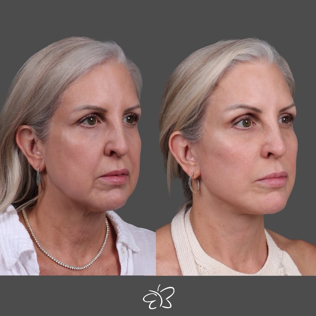 Instagram post by Dr. Edward Buckingham: Facial aging rarely happens in just one area, and the most natural results come from understanding how those changes work together. At 54, t…
