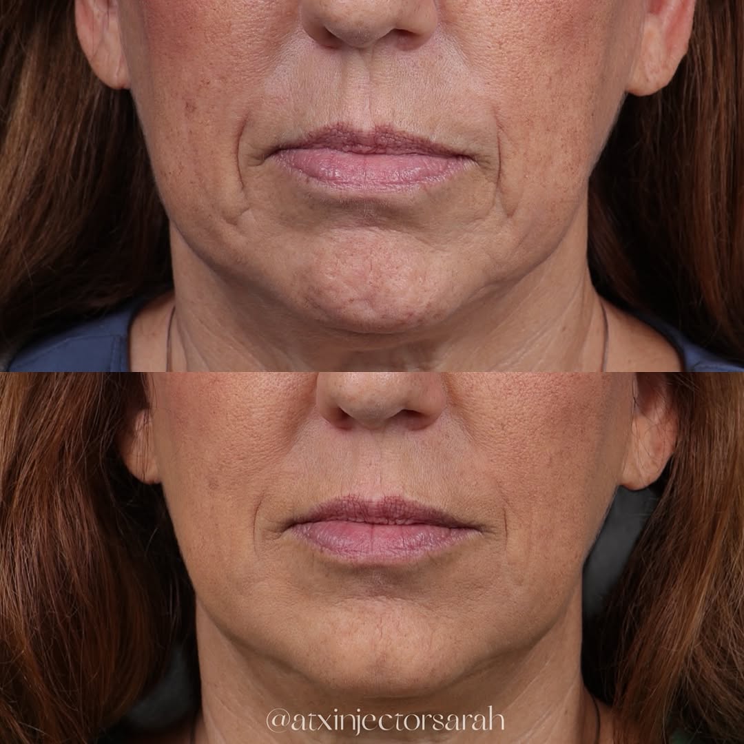 Instagram post by Dr. Edward Buckingham: Soft. Undetectable. Natural. Refreshed. 💉 Because the best filler is filler you can’t detect 🤌 I achieved this natural injectable filler r…