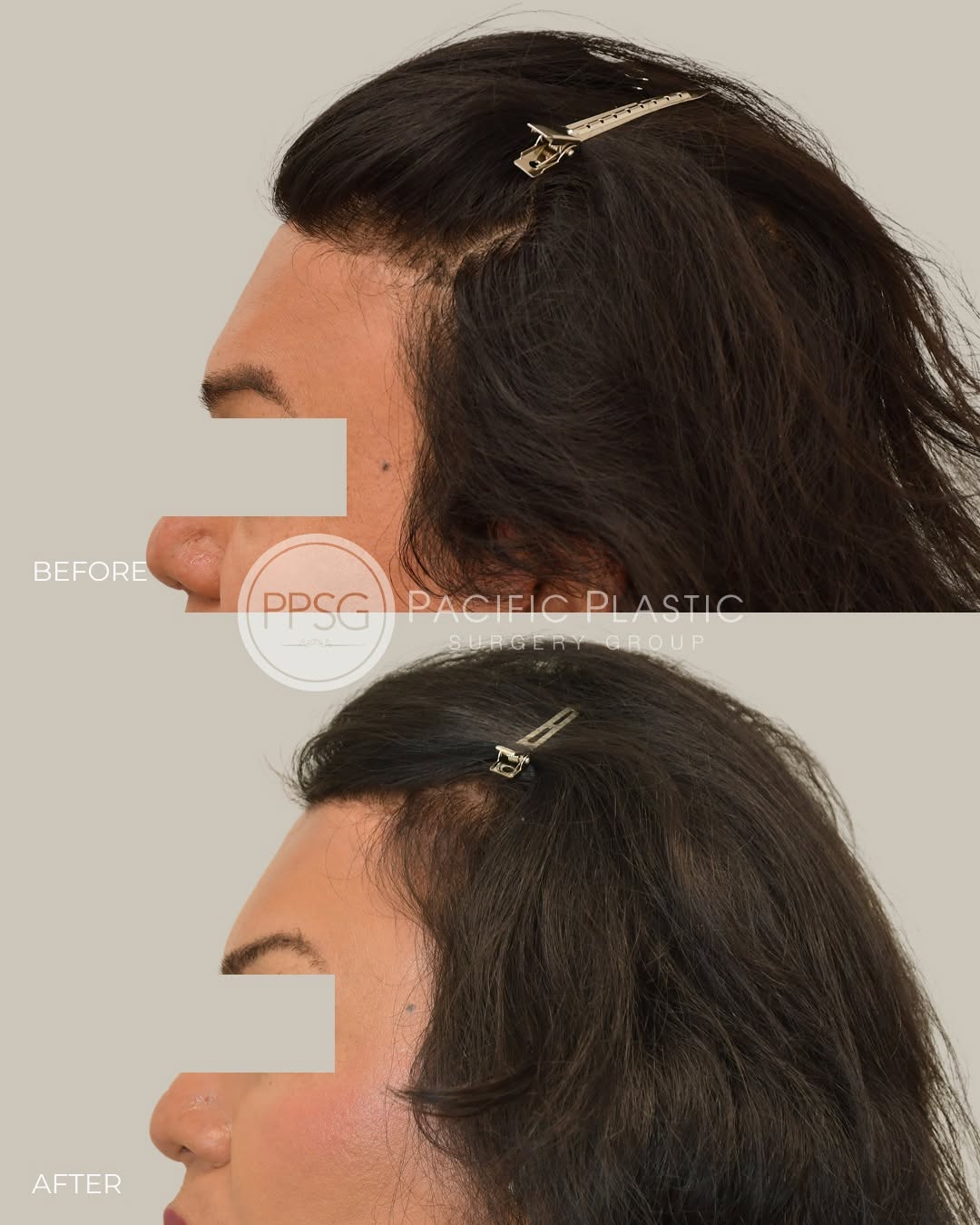 Instagram post by Dr. Edward P. Miranda: This patient wanted us to conceal her FFS scar with a gender affirming hair transplant. She wanted softer corners, and to cover the hairline…