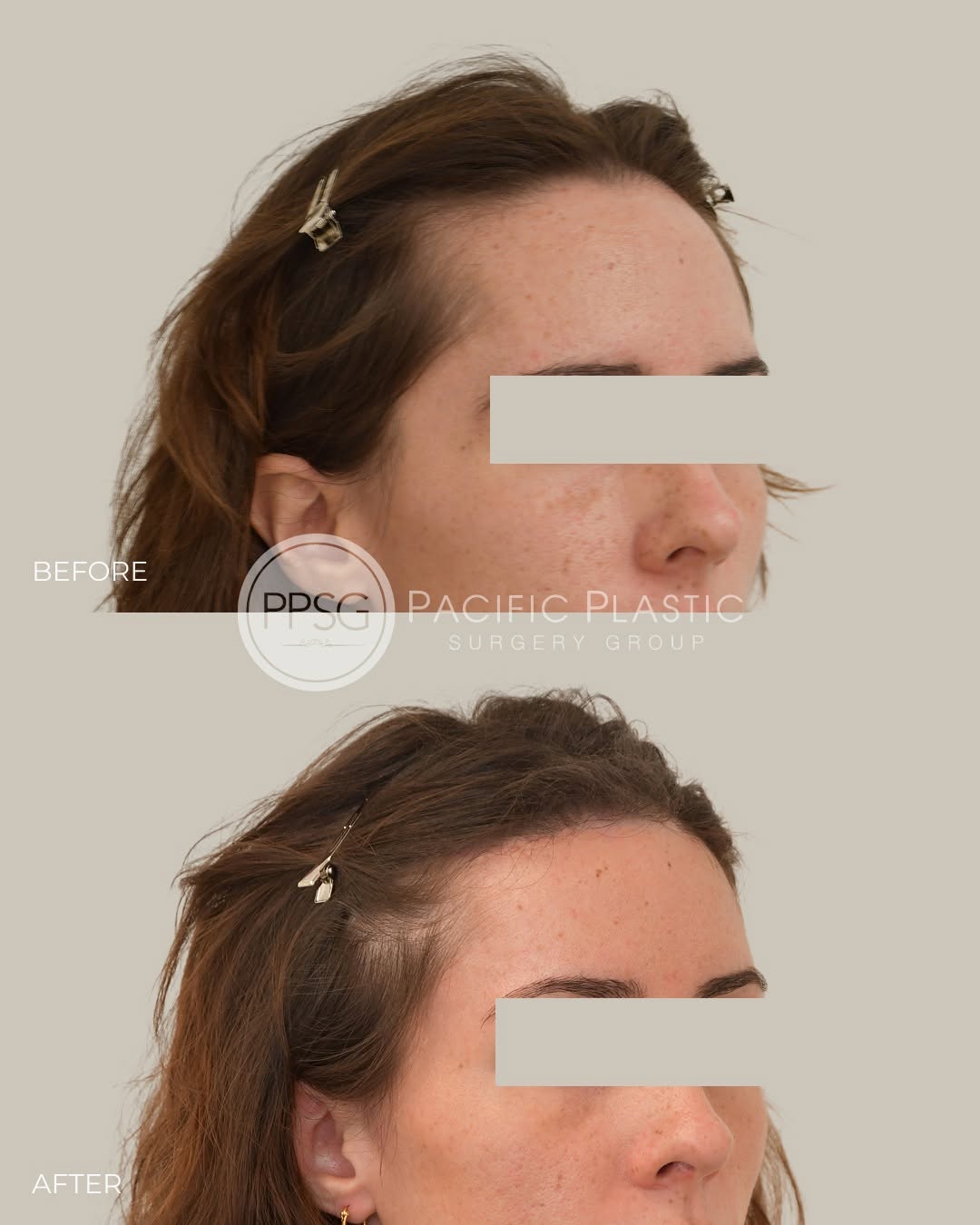 Instagram post by Dr. Edward P. Miranda: A high hairline can make the face appear longer or less harmonious. Hairline lowering surgery reshapes the frame of the face, creating softe…