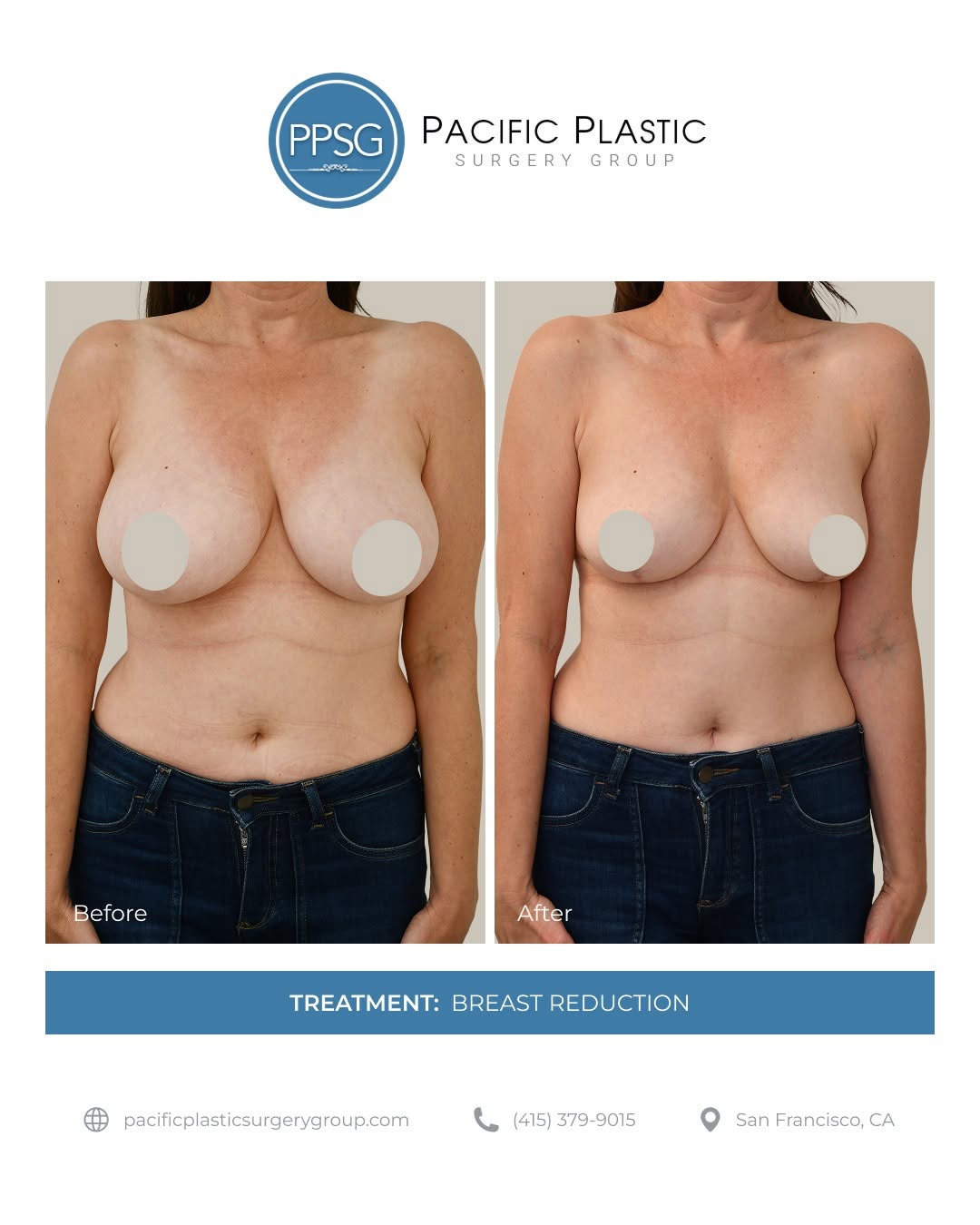 Instagram post by Dr. Edward P. Miranda: Breast reduction can relieve physical discomfort while creating a more balanced, proportionate silhouette. This result reflects refined cont…