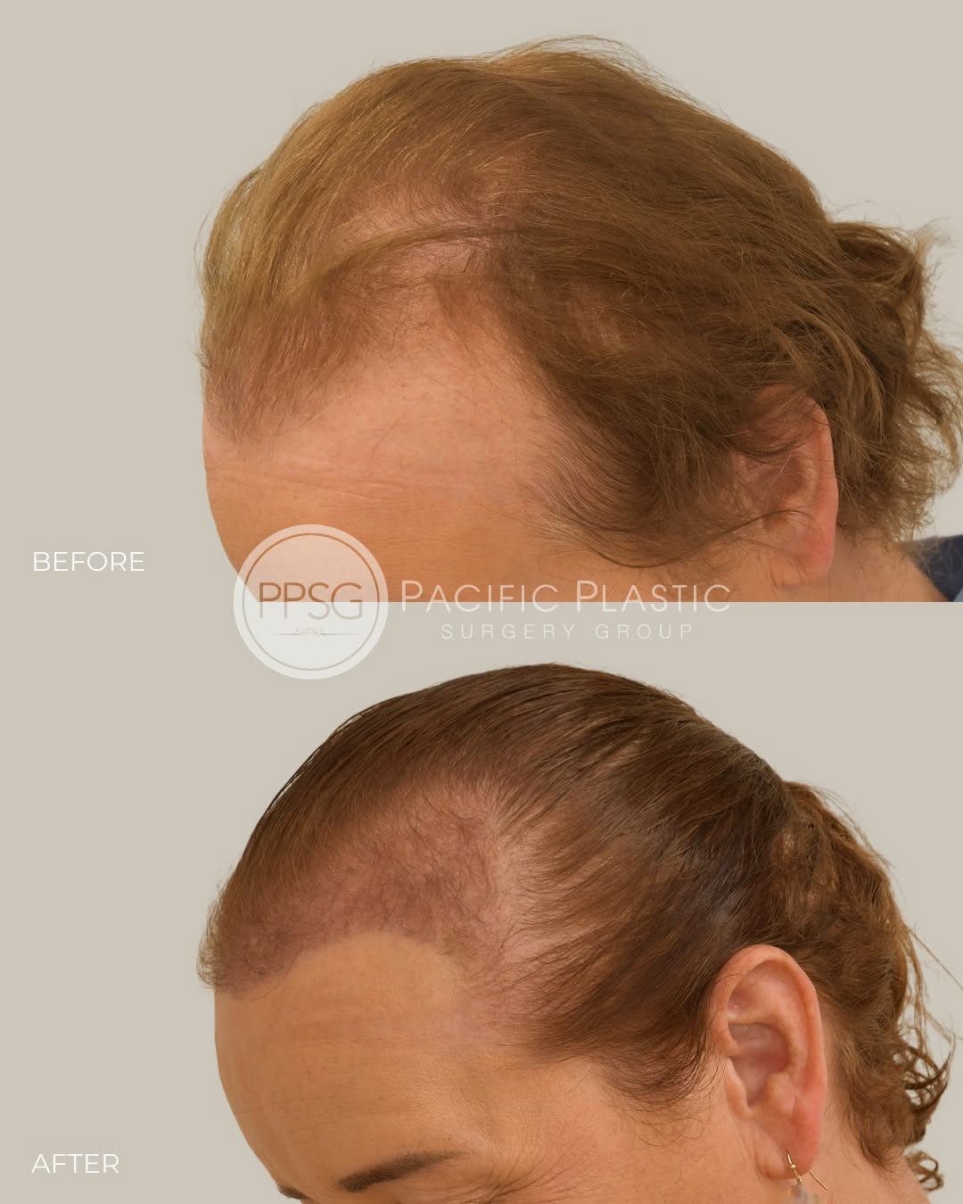 Instagram post by Dr. Edward P. Miranda: Early results for this patient’s hair transplant – grafts take approximately six months to reach full thickness; this patient is photographe…
