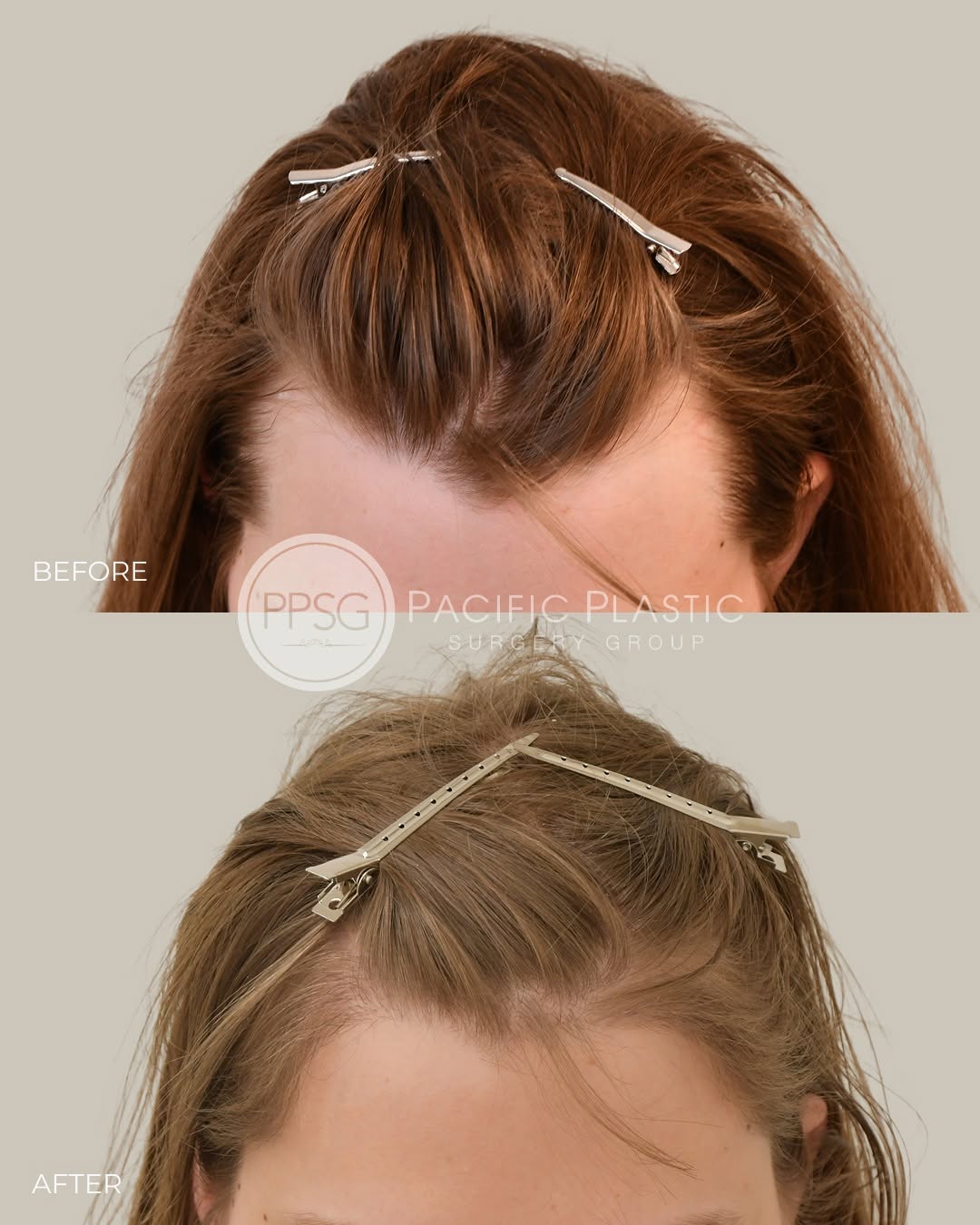 Instagram post by Dr. Edward P. Miranda: Another wonderful gender affirming hair transplant result – the patient wanted to fill in her widow’s peak hairline with a softer and more f…