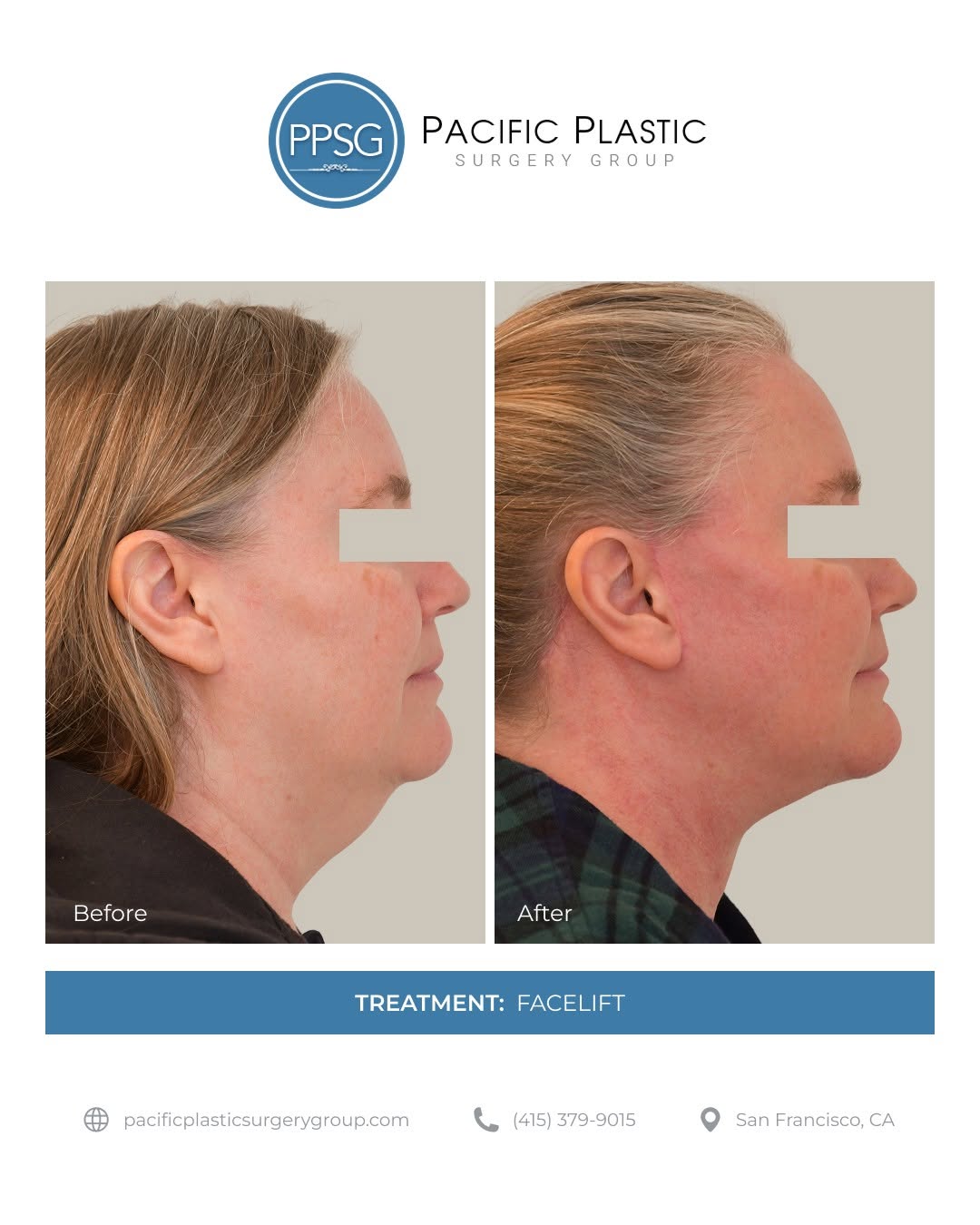 Instagram post by Dr. Edward P. Miranda: A facelift restores definition by repositioning deeper tissues and refining the jawline and neck. This result reflects a refreshed appearanc…