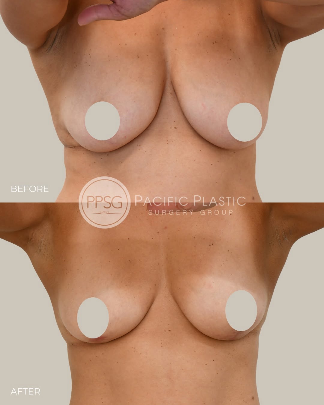 Instagram post by Dr. Edward P. Miranda: Subtle repositioning can make a meaningful difference. This breast lift enhances projection and firmness, creating a smoother, more proporti…