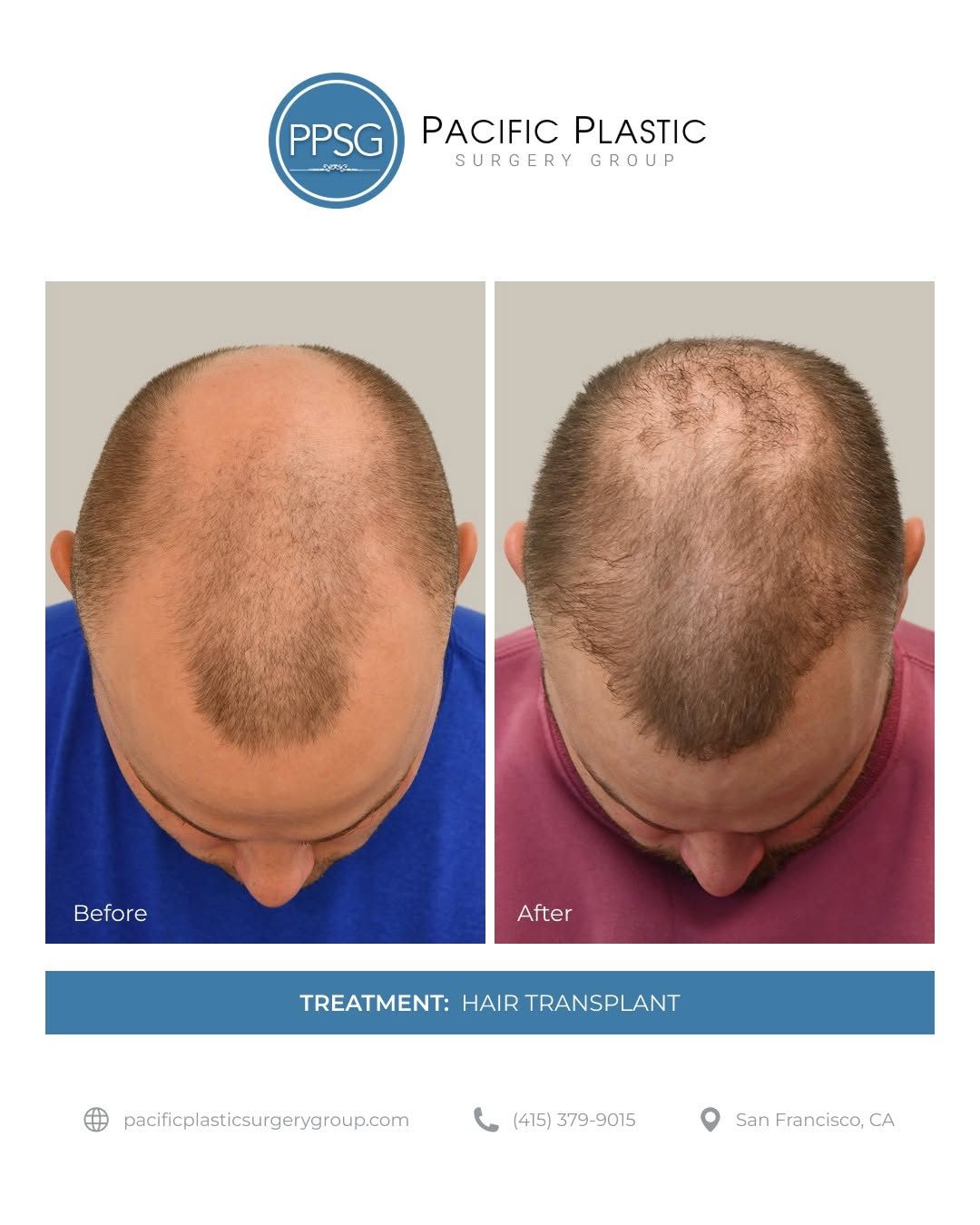 Instagram post by Dr. Edward P. Miranda: Subtle changes can make a noticeable impact. By rebuilding density along the hairline and crown, this transformation enhances overall balanc…