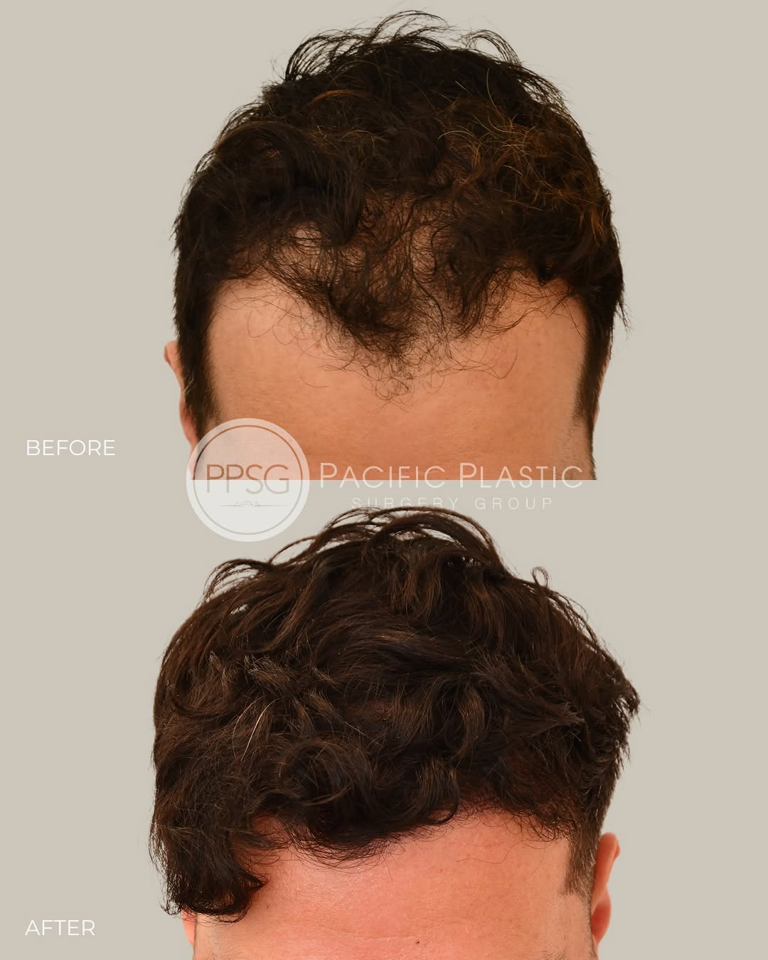 Instagram post by Dr. Edward P. Miranda: Every graft matters. Strategic placement and attention to direction allow transplanted hair to grow in seamlessly, restoring fullness and co…